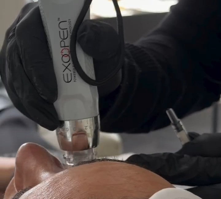 Practitioner treating the forehead with the EXOPEN electroporation microneedling device